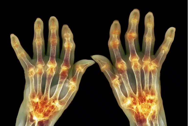 osteoarthritus